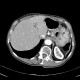 Parenchymal bleeding in liver after PTC (percutaneous transhepatic cholangiography) - before: CT - Computed tomography