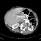 Parenchymal bleeding in liver after PTC (percutaneous transhepatic cholangiography) - before: CT - Computed tomography