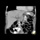 Parenchymal bleeding in liver after PTC (percutaneous transhepatic cholangiography) - before: CT - Computed tomography