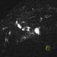 Parenchymal bleeding in liver after PTC (percutaneous transhepatic cholangiography) - before: MRI - Magnetic Resonance Imaging