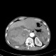 Parenchymal bleeding in liver after PTC (percutaneous transhepatic cholangiography) - after: CT - Computed tomography