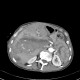 Parenchymal bleeding in liver after PTC (percutaneous transhepatic cholangiography) - after: CT - Computed tomography