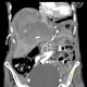 Parenchymal bleeding in liver after PTC (percutaneous transhepatic cholangiography) - after: CT - Computed tomography