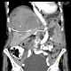 Parenchymal bleeding in liver after PTC (percutaneous transhepatic cholangiography) - after: CT - Computed tomography