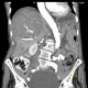 Parenchymal bleeding in liver after PTC (percutaneous transhepatic cholangiography) - after: CT - Computed tomography