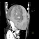 Parenchymal bleeding in liver after PTC (percutaneous transhepatic cholangiography) - after: CT - Computed tomography