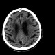 Leukoaraiosis: CT - Computed tomography