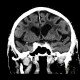 Leukoaraiosis: CT - Computed tomography