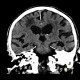 Leukoaraiosis: CT - Computed tomography