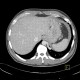 Anomalous blood supply from systemic circulation in left lower lung lobe: CT - Computed tomography
