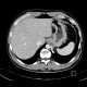 Anomalous blood supply from systemic circulation in left lower lung lobe: CT - Computed tomography