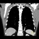 Anomalous blood supply from systemic circulation in left lower lung lobe: CT - Computed tomography