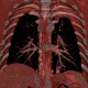 Anomalous blood supply from systemic circulation in left lower lung lobe: CT - Computed tomography
