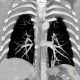 Anomalous blood supply from systemic circulation in left lower lung lobe: CT - Computed tomography