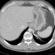 Anomalous blood supply from systemic circulation in left lower lung lobe: CT - Computed tomography