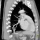 Anomalous blood supply from systemic circulation in left lower lung lobe: CT - Computed tomography
