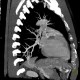 Anomalous blood supply from systemic circulation in left lower lung lobe: CT - Computed tomography