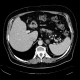 Lipoma in duodenum, small	: CT - Computed tomography