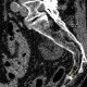 Fibrolipoma in pelvis: CT - Computed tomography
