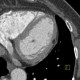 Lipoma of left ventricle: CT - Computed tomography