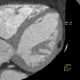 Lipoma of left ventricle: CT - Computed tomography