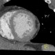 Lipoma of left ventricle: CT - Computed tomography