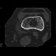 Lipohemarthros, fracture of knee, depression fracture of tibial plateau: CT - Computed tomography
