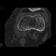 Lipohemarthros, fracture of knee, depression fracture of tibial plateau: CT - Computed tomography