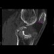 Lipohemarthros, fracture of knee, depression fracture of tibial plateau: CT - Computed tomography