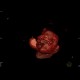 Lipohemarthros, fracture of knee, depression fracture of tibial plateau: CT - Computed tomography