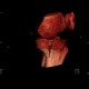 Lipohemarthros, fracture of knee, depression fracture of tibial plateau: CT - Computed tomography