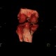 Lipohemarthros, fracture of knee, depression fracture of tibial plateau: CT - Computed tomography