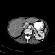 Nutcracker syndrome, aortomesenteric compression: CT - Computed tomography
