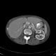 Nutcracker syndrome, aortomesenteric compression: CT - Computed tomography