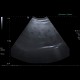 Steatosis, fatty liver, focal sparing: US - Ultrasound