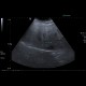 Steatosis, fatty liver, focal sparing: US - Ultrasound