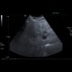 Steatosis, fatty liver, focal sparing: US - Ultrasound