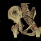 Fracture of pelvis, pubic bone, subluxation of sacrum, VRT: CT - Computed tomography