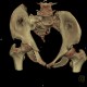 Fracture of pelvis, pubic bone, subluxation of sacrum, VRT: CT - Computed tomography