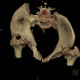 Fracture of pelvis, pubic bone, subluxation of sacrum, VRT: CT - Computed tomography