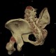 Fracture of pelvis, pubic bone, subluxation of sacrum, VRT: CT - Computed tomography