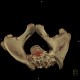 Fracture of pelvis, pubic bone, subluxation of sacrum, VRT: CT - Computed tomography