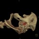 Fracture of pelvis, pubic bone, subluxation of sacrum, VRT: CT - Computed tomography