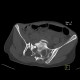 Fracture of pelvis, pubic bone, subluxation of sacrum: CT - Computed tomography