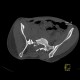 Fracture of pelvis, pubic bone, subluxation of sacrum: CT - Computed tomography