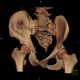 Fracture of pelvis, pubic bone, subluxation of sacrum, VRT: CT - Computed tomography