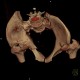 Fracture of pelvis, pubic bone, subluxation of sacrum, VRT: CT - Computed tomography