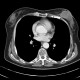 Lymphoma of breast: CT - Computed tomography