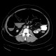 Large bowel ileus: CT - Computed tomography