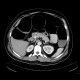 Large bowel ileus: CT - Computed tomography